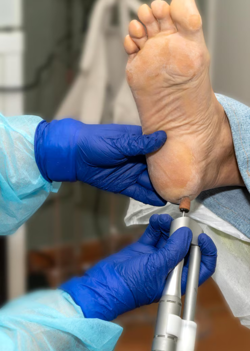 Diabetic Foot Care